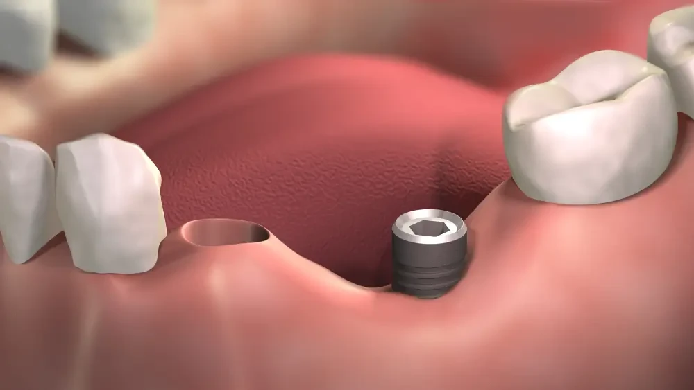 Двухэтапная имплантация в Нижнем Новгороде