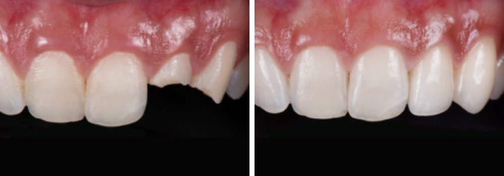 Восстановление двух сильно разрушенных зубов штифтами и стеклокерамическими коронками в ARTDENT