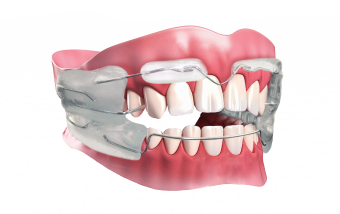 Съемные ортодонтические аппараты в Нижнем Новгороде ARTDENT