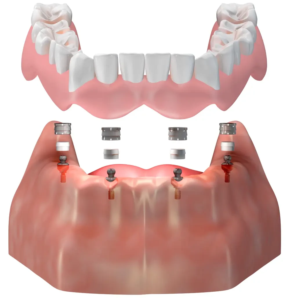 Методики Все на 4 и Все на 6 в ARTDENT