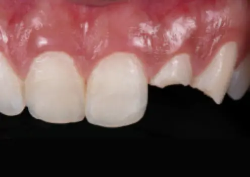 Сильные сколы резца и клыка после травмы