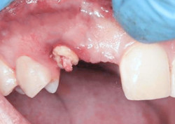 Глубокий перелом зуба