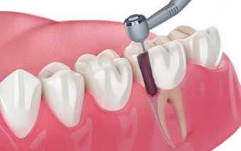 Лечение пульпита в Нижнем Новгороде ARTDENT