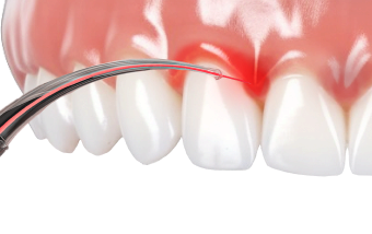 Лазерная хирургия в Нижнем Новгороде