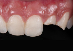 Пациент до установки коронки на зуб