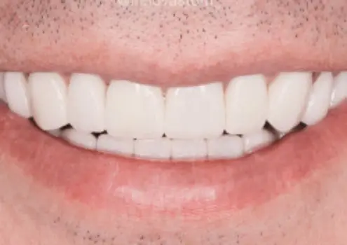 Восстановление мелких сколов на передних и нижних зубах керамическими винирами в клинике «Артдент»