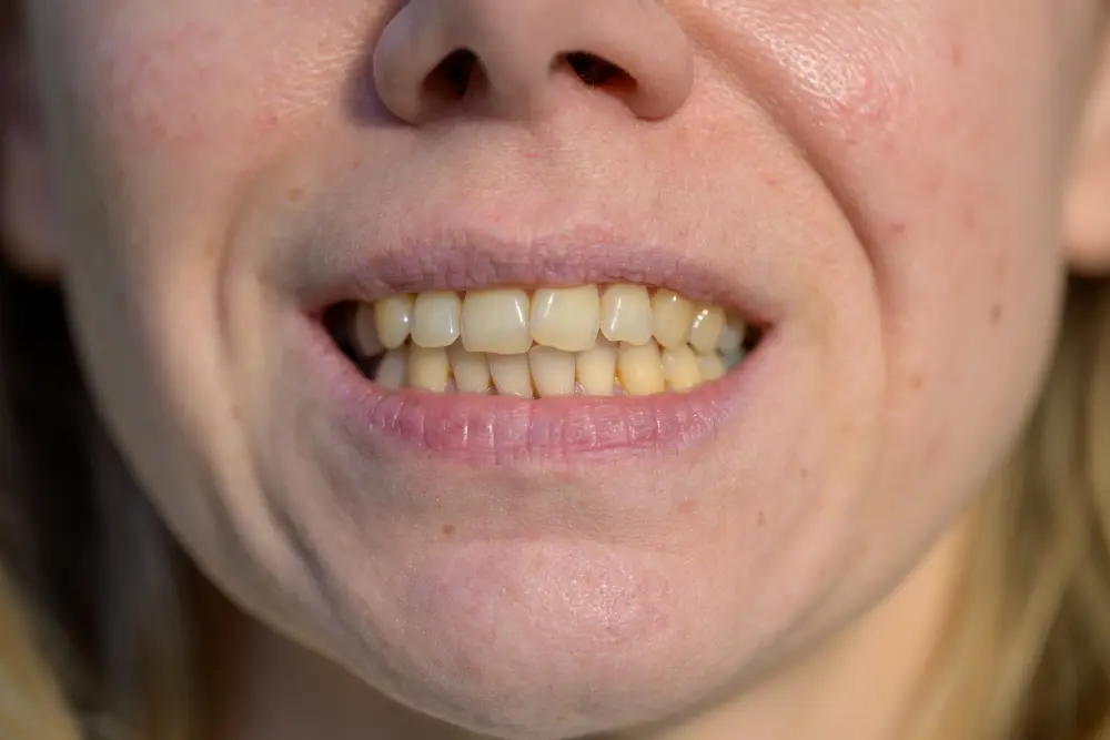 Пигментированный налет