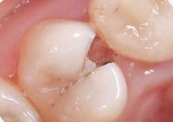 Средний скол дентина