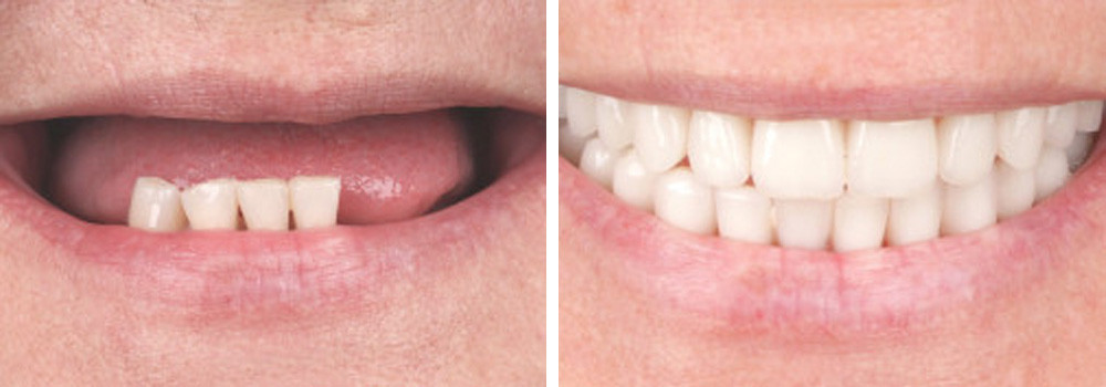 Полная реставрация двух челюстей по протоколу All-on-4 на южнокорейских имплантатах ST