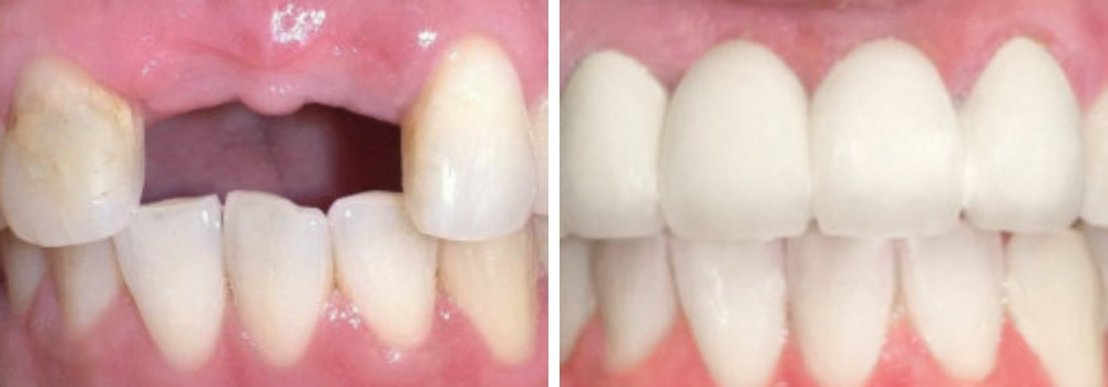 Установка несъемного моста из циркония с опорой на собственные зубы в стоматологии «АртДент»