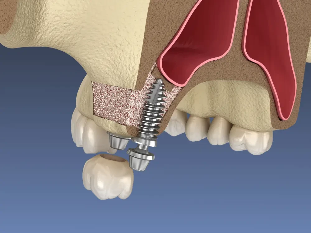 Одномоментная имплантация в Нижнем Новгороде