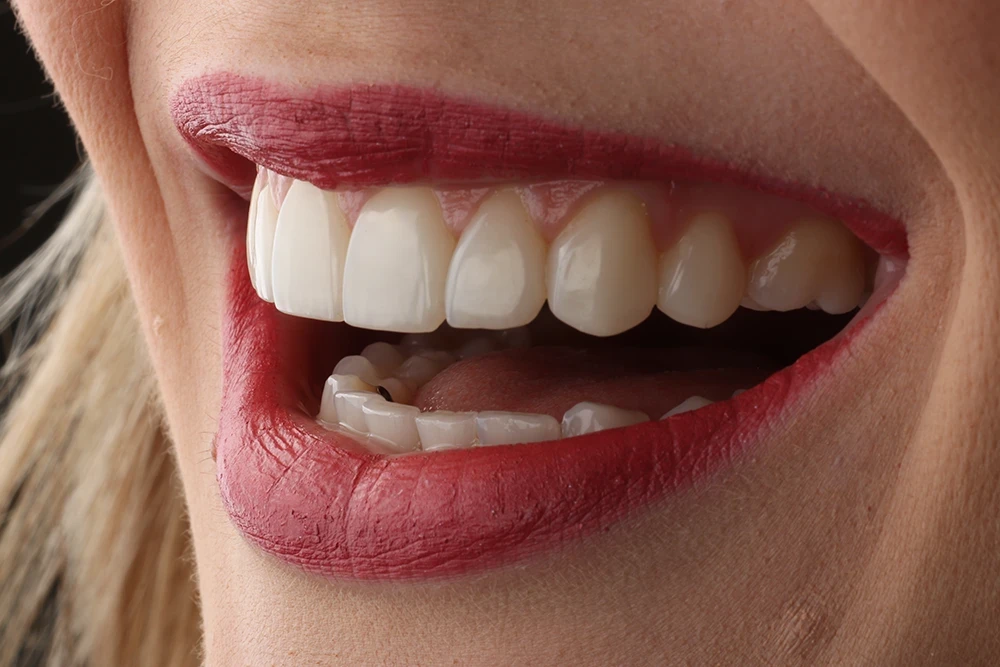Женская улыбка с композитными винирами