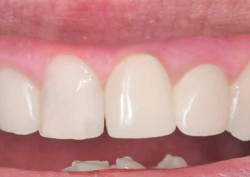 Пациент после установки коронки на зуб