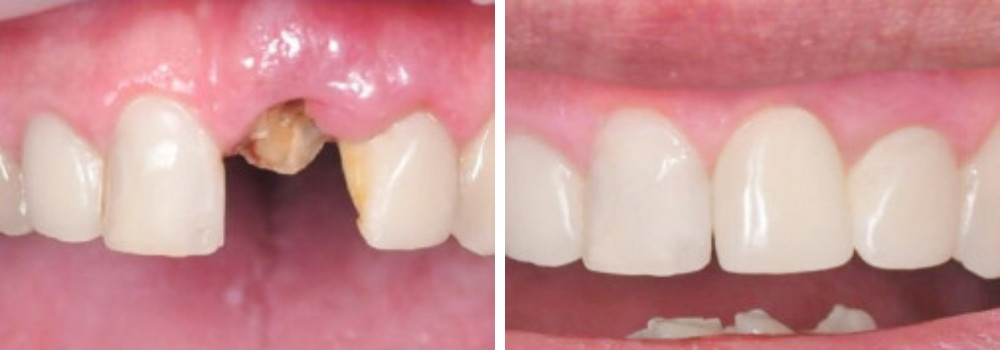 Восстановление переднего зуба имплантом и коронкой из циркония в ARTDENT