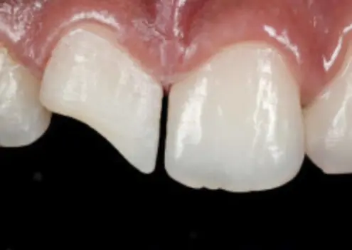 скол переднего резца