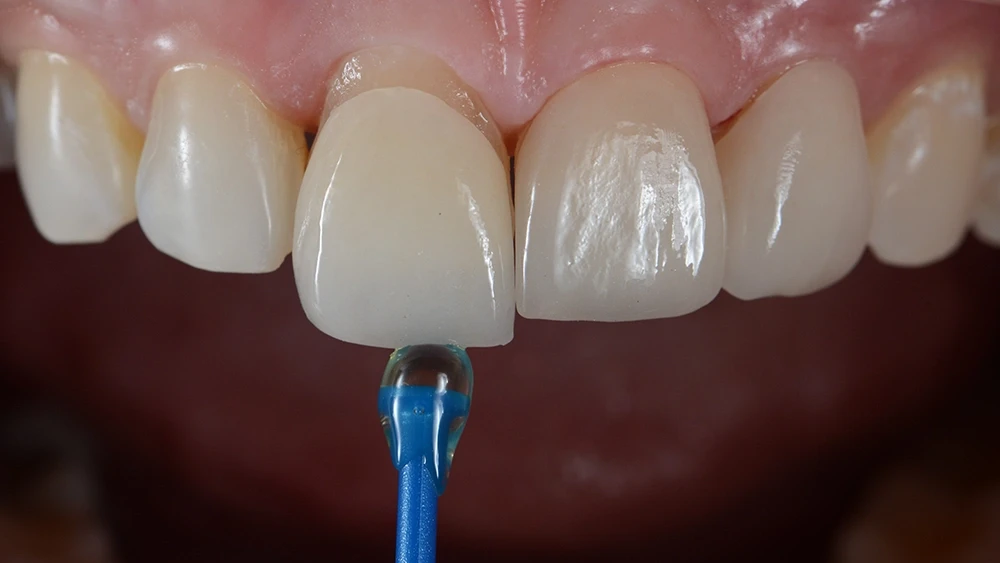 До лечения рецессии и гипертрофии в стоматологии «АртДент