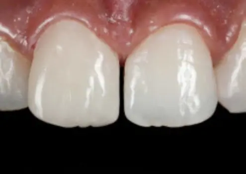 Художественная реставрация скола на резце композитными материалами в стоматологии «Артдент»