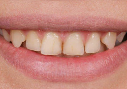 Маленький скол эмали