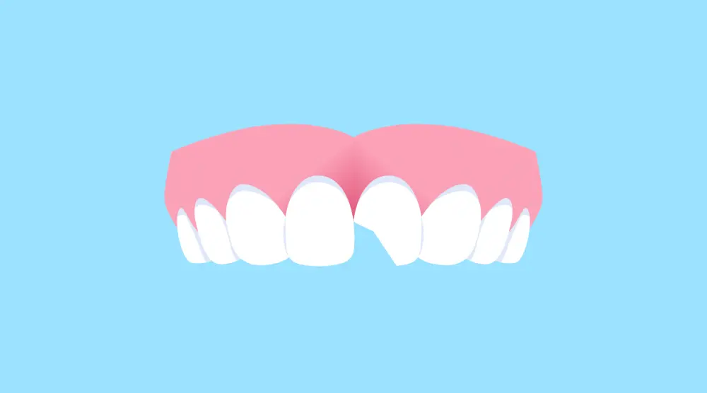 Что такое скол зуба