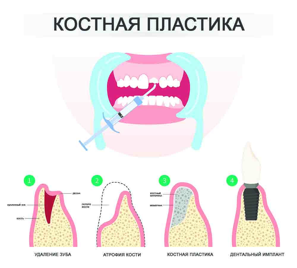 Открытый синус-лифтинг в АРТДЕНТ