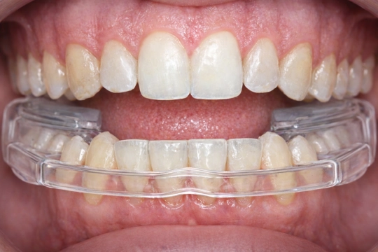 окклюзионная шина