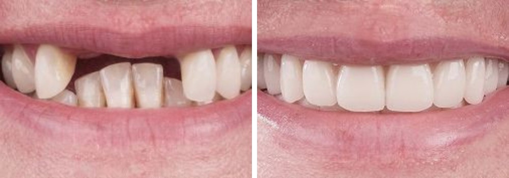 Установка частичного съемного протеза «бабочка» на верхние передние зубы в клинике ARTDENT