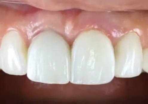 Восстановление обширного скола зуба имплантом JD и циркониевой коронкой в стоматологии «Артдент»