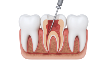  Лечение каналов зубов в Нижнем Новгороде ARTDENT