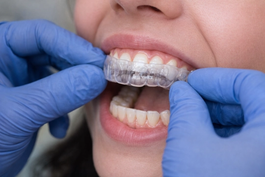 примерка защитной капы на зубы