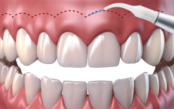 Профилактика кариеса в Нижнем Новгороде ARTDENT