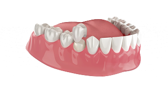 Коронки Emax и диоксид циркония в Нижнем Новгороде ARTDENT
