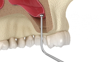 Костная пластика и синус-лифтинг в Нижнем Новгороде