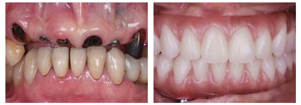 Восстановление зубов на верхней челюсти 4 имплантатами AnyRidge и полным несъемным протезом