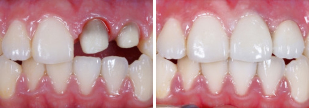 Реставрация двух передних зубов коронками E.MAX в стоматологии «АртДент»