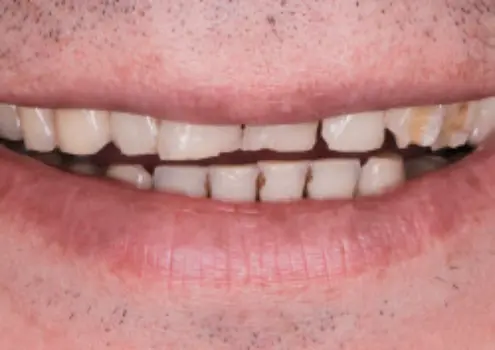 Мелкие сколы на передних и нижних зубах