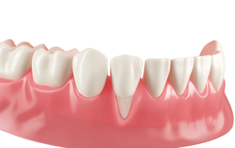 Закрытие рецессий в Нижнем Новгороде