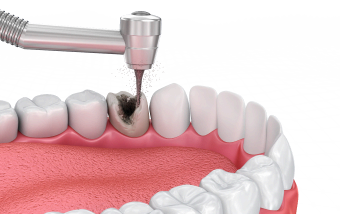 Лечение кариеса в Нижнем Новгороде ARTDENT