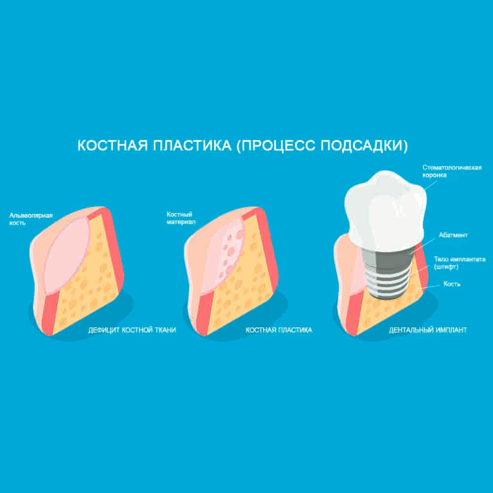 Закрытый синус-лифтинг в АРТДЕНТ