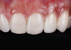 Пациент после установки коронки на зуб