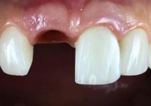 Обширный скол зуба