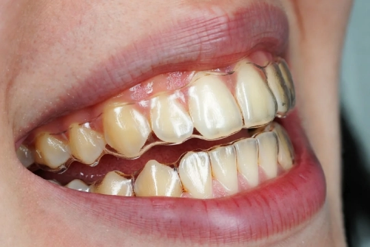 Прозрачные каппы