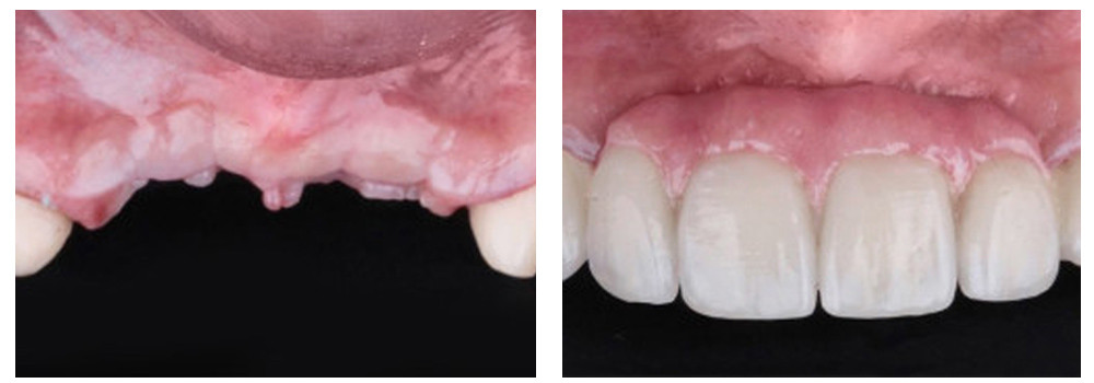 Устранение частичной адентии верхней челюсти на 3-х имплантах Strauman в ArtDent