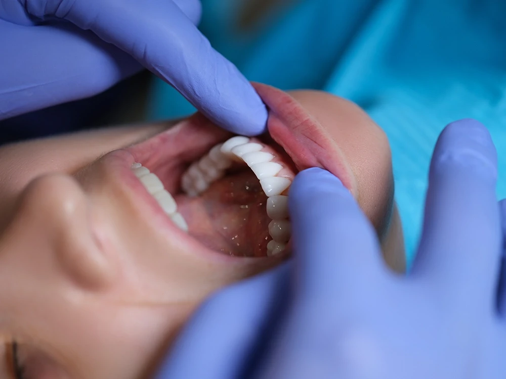 Установка виниров