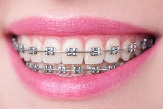 коррекция прикуса брекетами