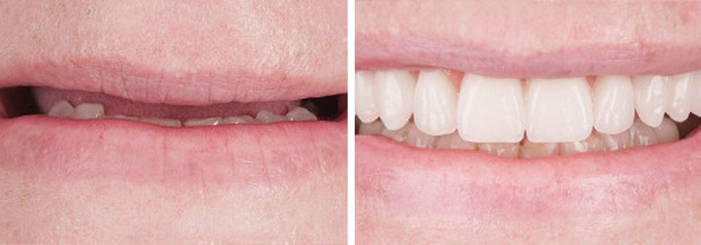 Реставрация частично беззубой верхней челюсти 4 имплантатами Lenmiriot и несъемным протезом