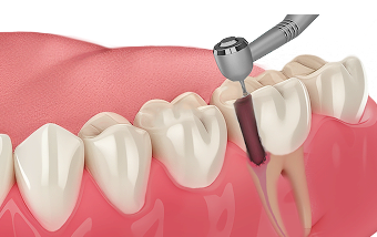 Подготовка к протезированию - лечение в Нижнем Новгороде