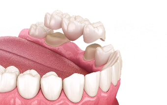 Установка коронок в Нижнем Новгороде ARTDENT