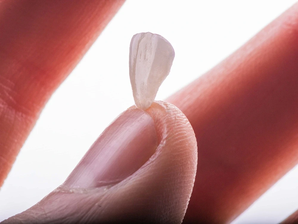 Керамический винир