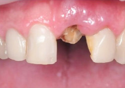 Пациент до установки коронки на зуб