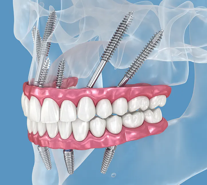 Птеригоидная стратегическая имплантация